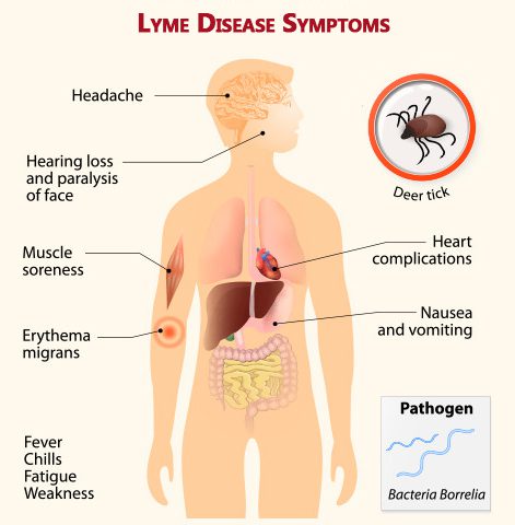 symptoms-of-lyme-disease