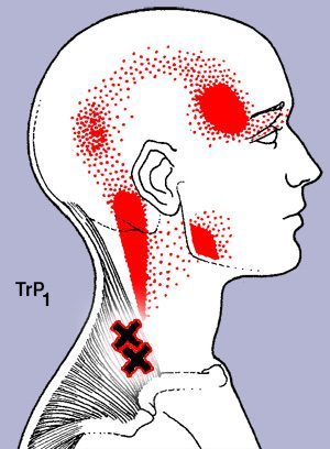 Trapezius Trigger Points: Causes, Treatment, and Prevention