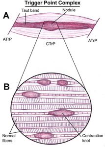 trigger-point-complex