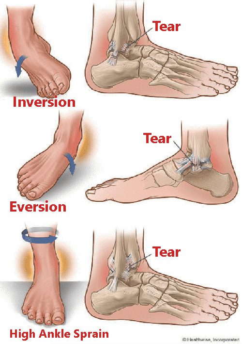 Ankle Sprains: How Physical Therapy Can Help! < Hampton Physical