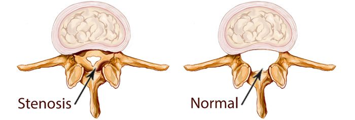 spine stenosis vs normal spine and how PT from Hampton PT can help