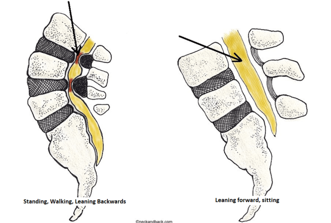 What Are the Final Stages of Spinal Stenosis? - BenchMark Physical Therapy