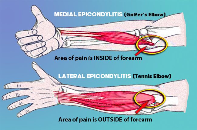 ateral epicondylitis or tennis elbow - medial epicondylitis or golfer’s elbow