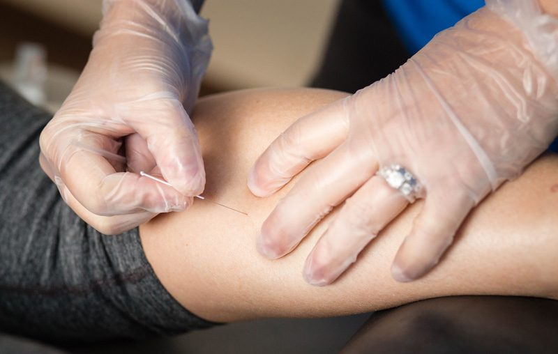 dry needling - Hampton NH Physical Therapy
