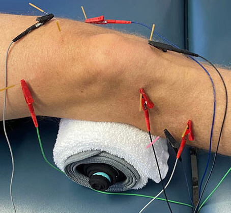 Hampton Physical Therapy treatment - dry needling