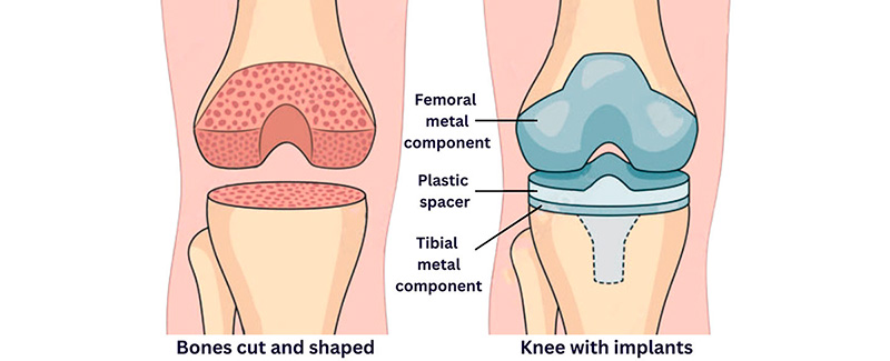 Hampton Physical Therapy treatment for knees such as replacement